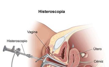 Histeroscopia