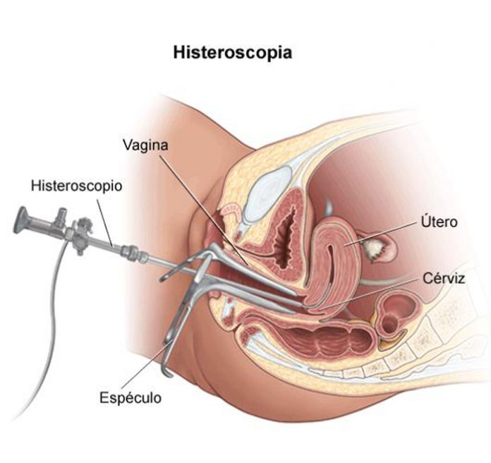 Histeroscopia