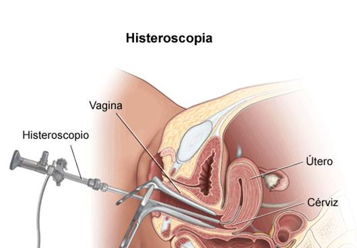 Histeroscopia