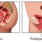 Prolapso uterino