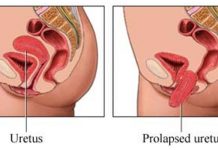 Prolapso uterino