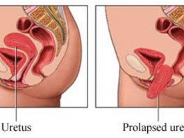 Prolapso uterino