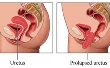 Prolapso uterino