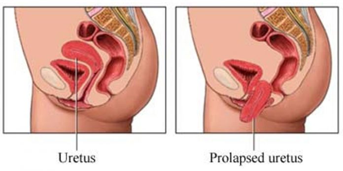 Prolapso uterino