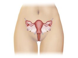 Endometriose, a principal causa da infertilidade feminina