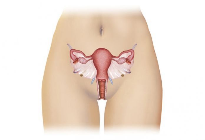 Endometriose, a principal causa da infertilidade feminina